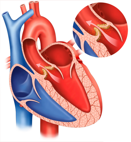 Aortic Valve Disease Illustration